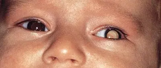 眼睛母细胞瘤症状图片图片